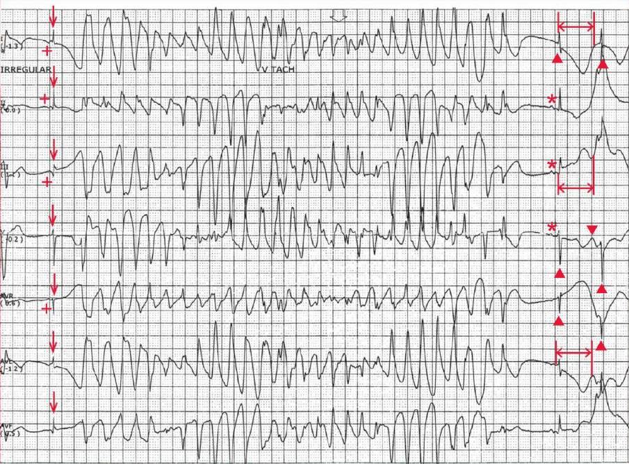 Torsade de pointes (nonsustained polymorphic ventricular tachycardia associated with a long QT interval)