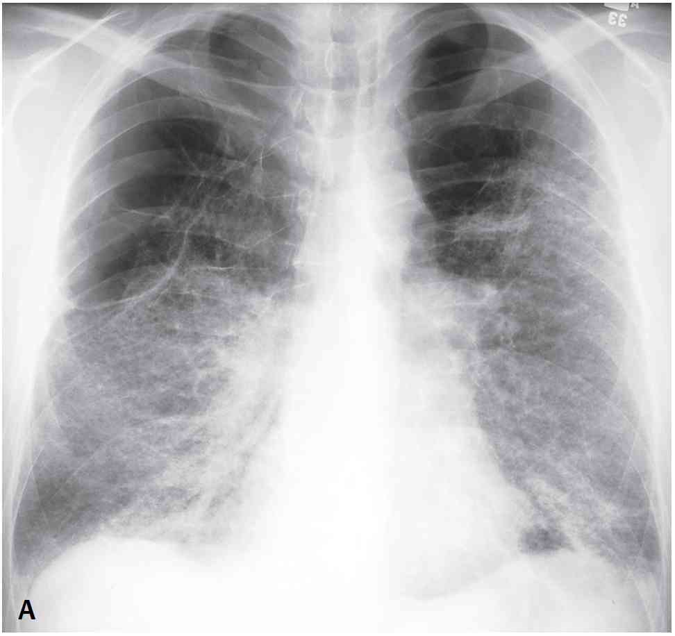 Read more about the article 46-year-old Man with Dyspnea