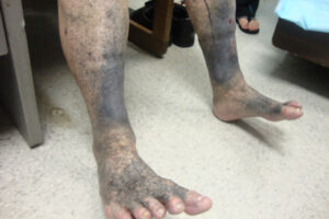 Grey Blue Rash 87-year-old Man with Blue-Gray Pigmentation - Manual of Medicine