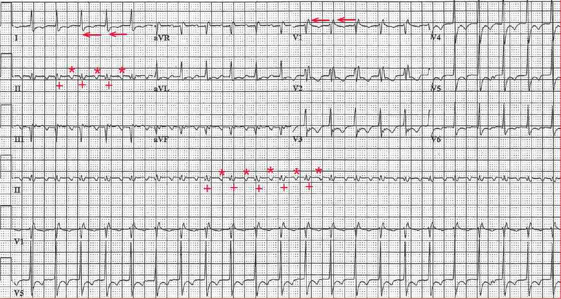 Atrial flutter with 2:1 conduction and RBBB