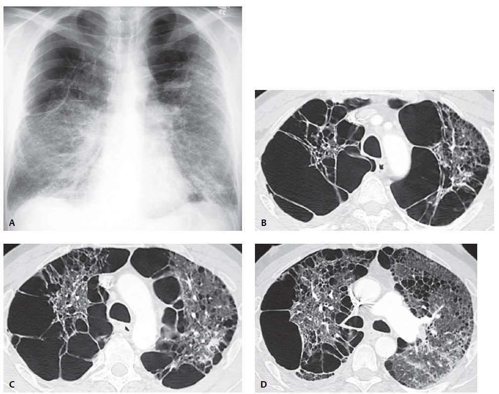 Bullous Lung Disease and Distal Acinar Emphysema