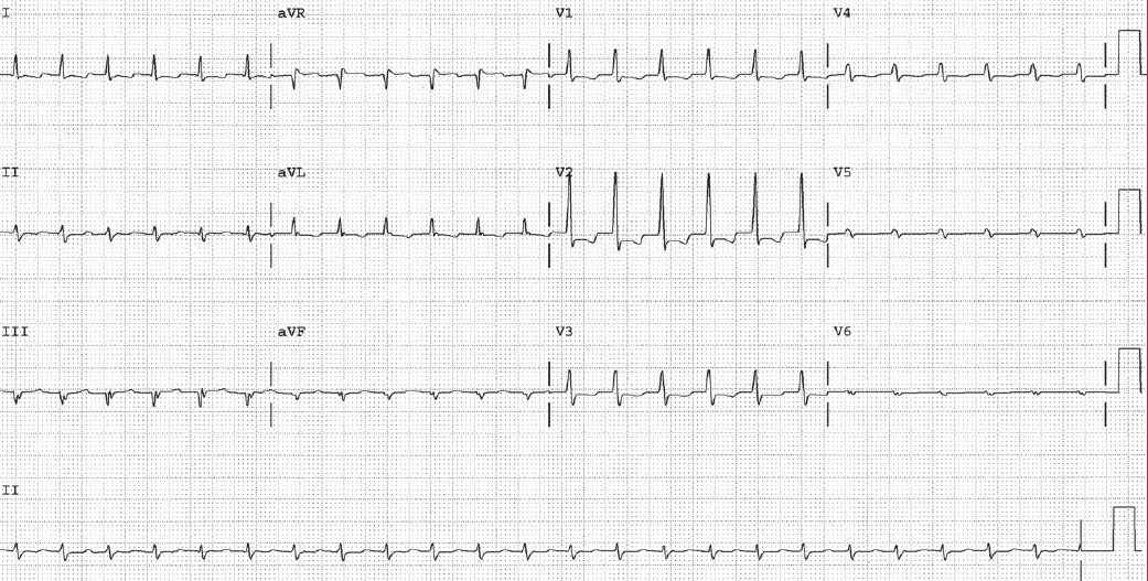 Read more about the article <strong>ECG Case 139</strong>