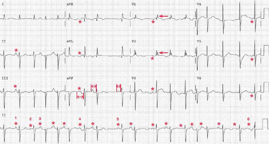 Multifocal atrial tachycardia, left anterior fascicular block (LAFB) and Incomplete RBBB