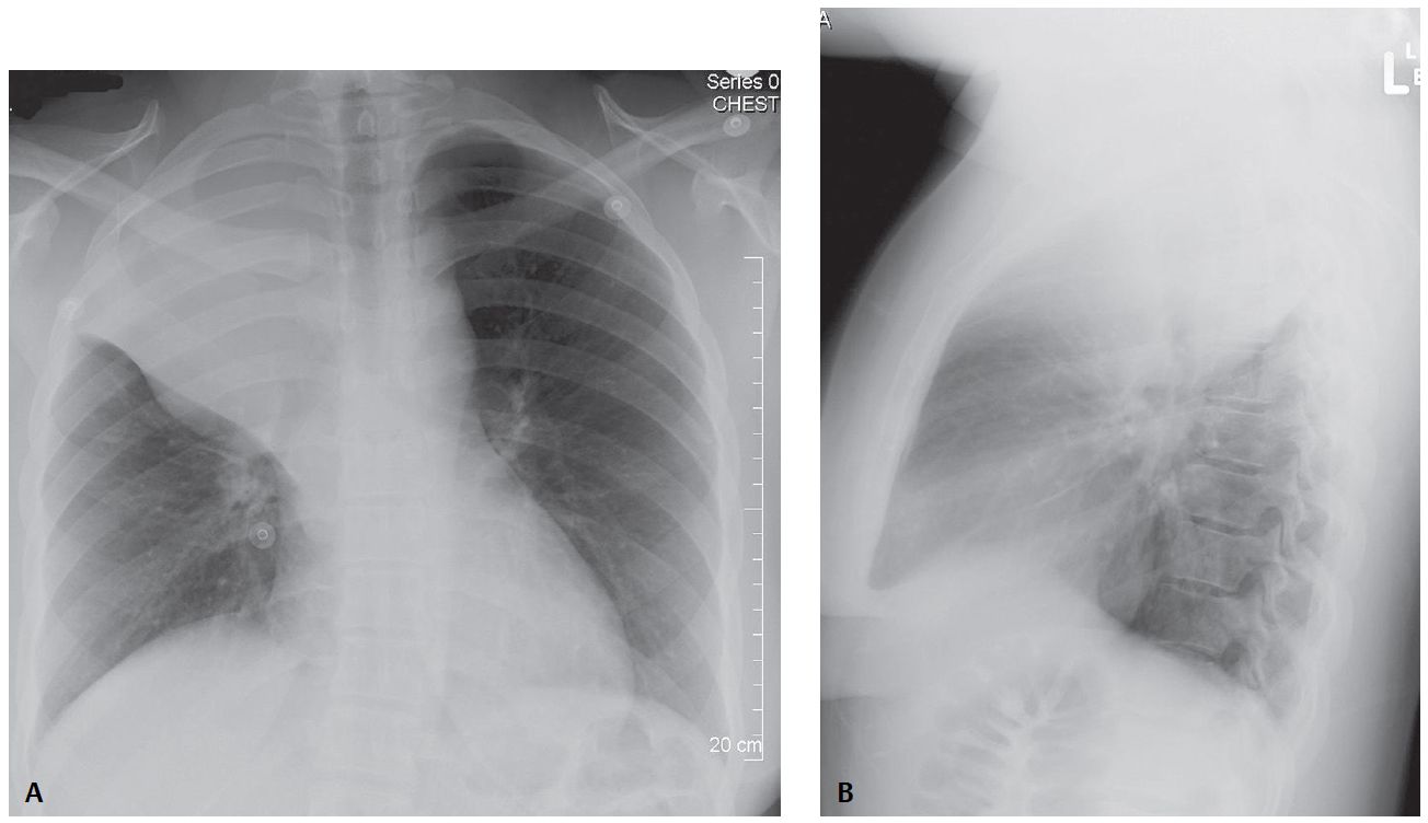Complicated Right Upper Lobe Atelectasis; Lymphoma with “Reverse ‘S’ Sign of Golden”
