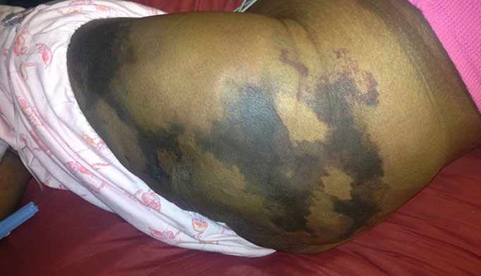 Read more about the article 38-year-old Female with Painful Patches and Plaques