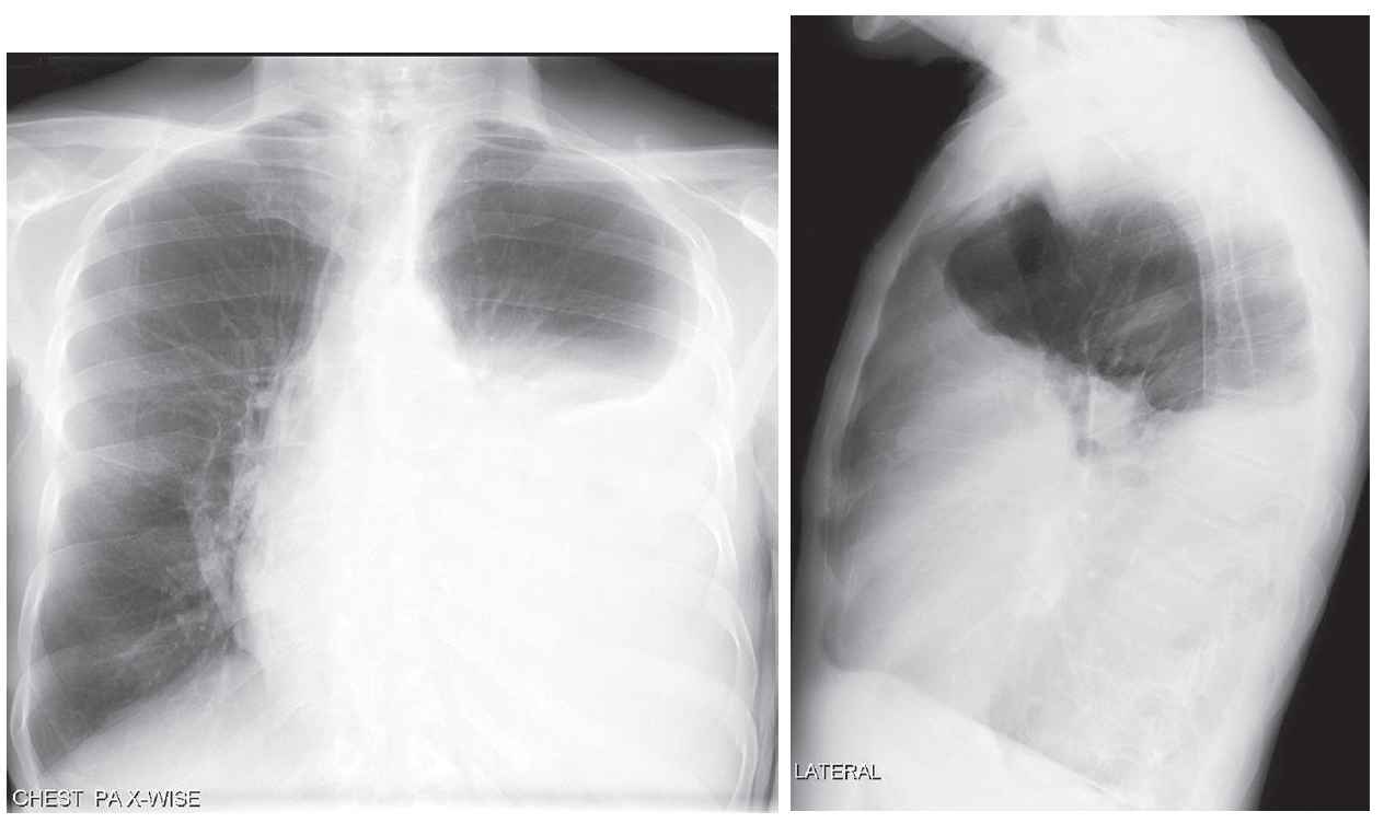 Read more about the article 72-year-old Man with Dyspnea and Left-sided Pleuritic Chest Pain