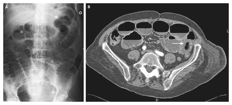 Small-Bowel Obstruction on Abdominal X-ray and CT