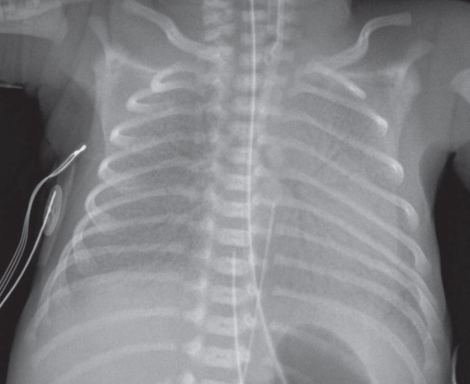 Adhesive Atelectasis: Respiratory Distress Syndrome (RDS) of the Newborn