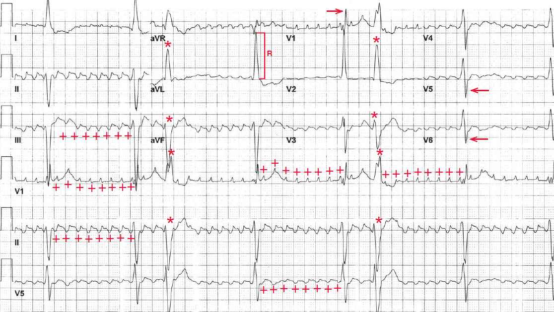 Atrial Flutter with 8:1 Conduction, PVCs, and Bifascicular Block