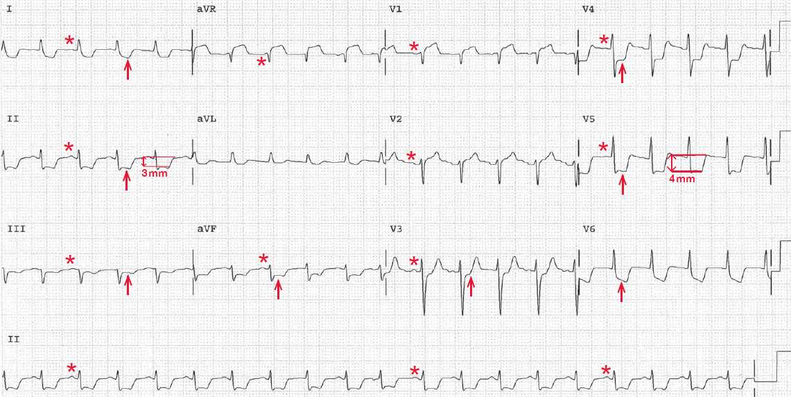 Diffuse Subendocardial Ischemia (Multivessel Coronary Disease, Proximal LAD or Left Main Artery Disease)