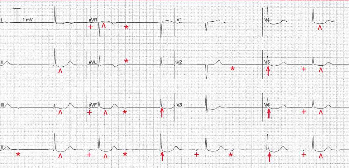 Atrial rhythm with 2:1 AV block with a junctional escape, digoxin effect, possible digoxin toxicity