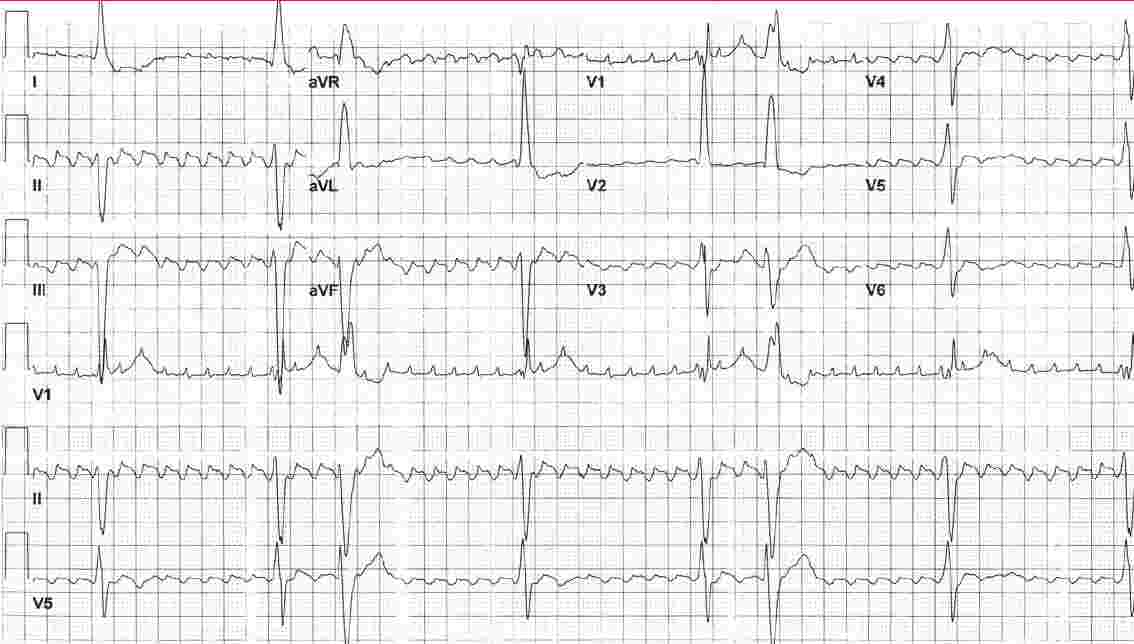 Read more about the article ECG Case 143