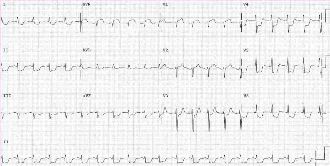 Read more about the article ECG Case 146