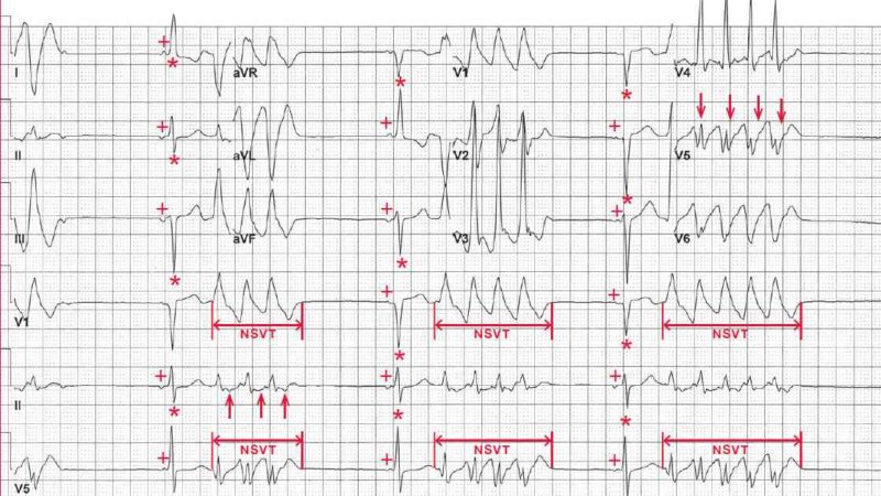 ECG Case 142: Ectopic Atrial Rhythm, Monomorphic Nonsustained VT ...