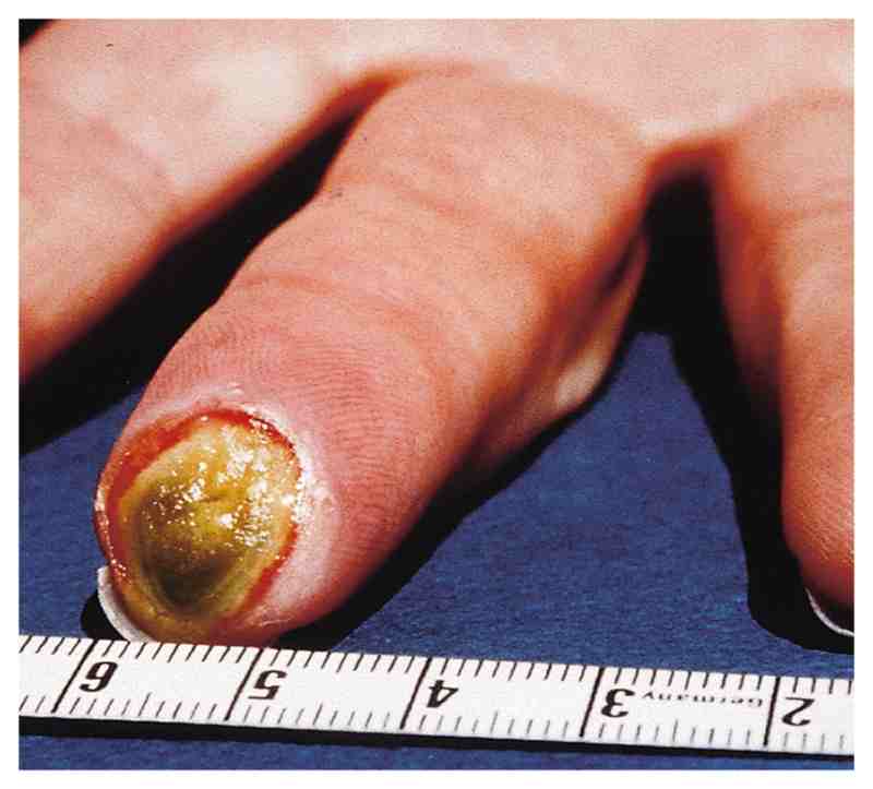 Read more about the article Smoker with an Ulcer on the Tip of the Finger