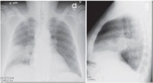 High Fever and Cough with Rusty, Blood-Streaked Sputum - Manual of Medicine