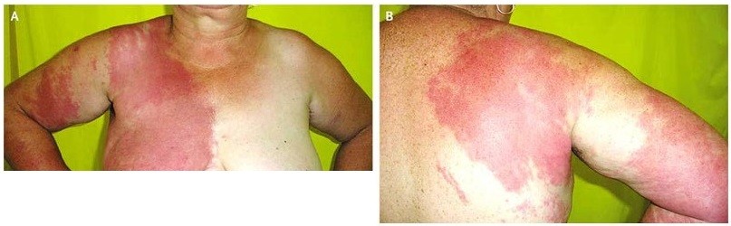 Read more about the article Patient with Acute Onset of Erythema