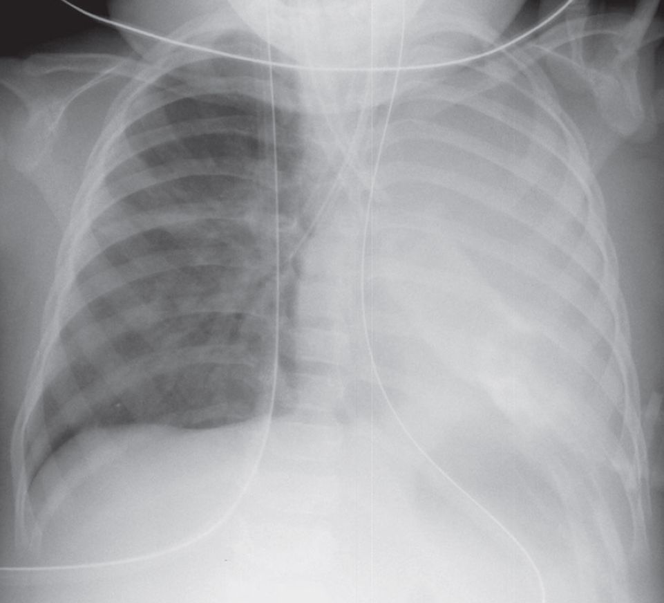 Total Atelectasis of Left Lung from Inadvertent Right Mainstem Bronchial Intubation
