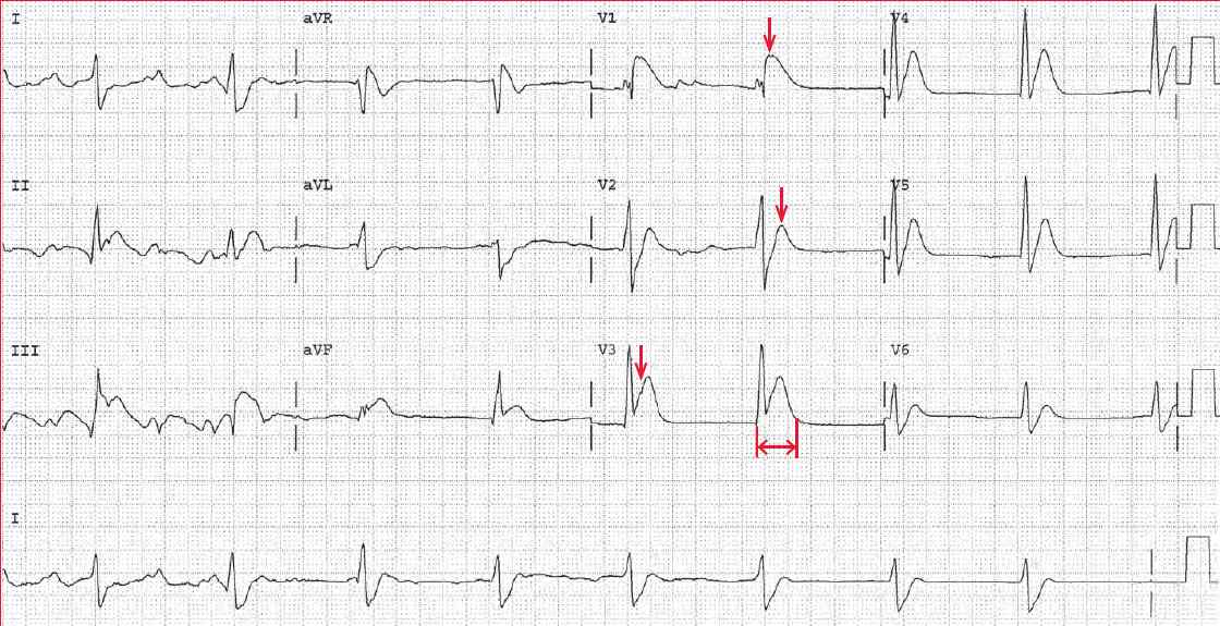 Short QT Interval due to Hypercalcemia