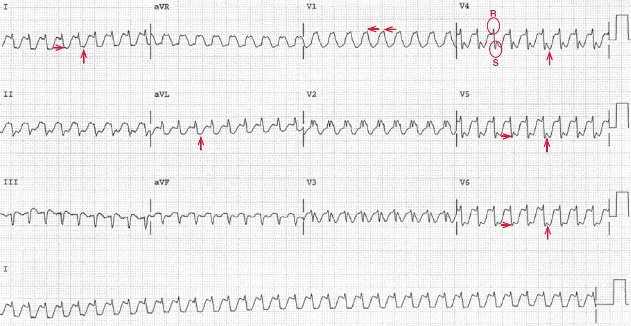 AVNRT with rate related RBBB and LAFB