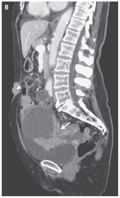 CT Abdomen showing pelvic mass, moderate ascites, peritoneal carcinomatosis, and a nodule in the umbilical region
