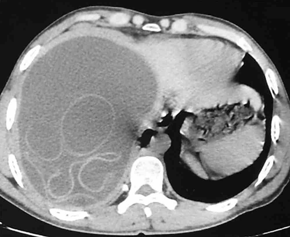 Read more about the article Hepatomegaly with a Palpable Hepatic Mass