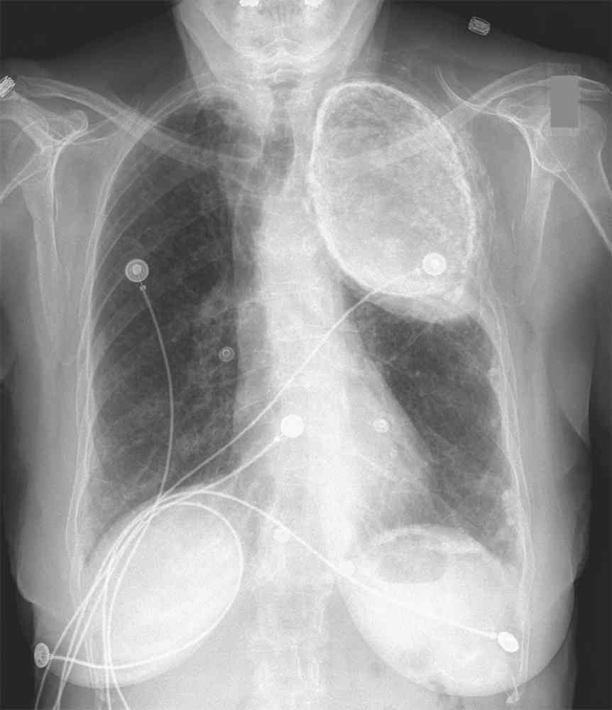 Read more about the article Incidental Finding on Chest X-Ray