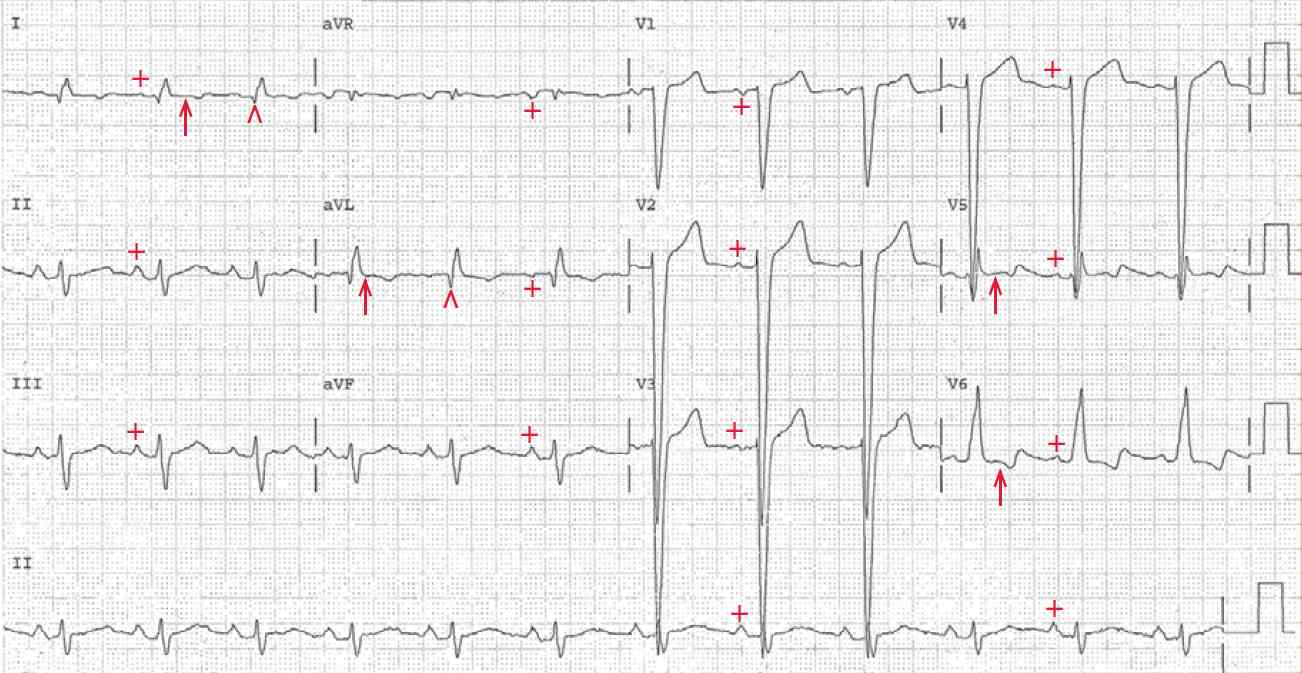 Normal sinus rhythm with intraventricular conduction delay (IVCD)