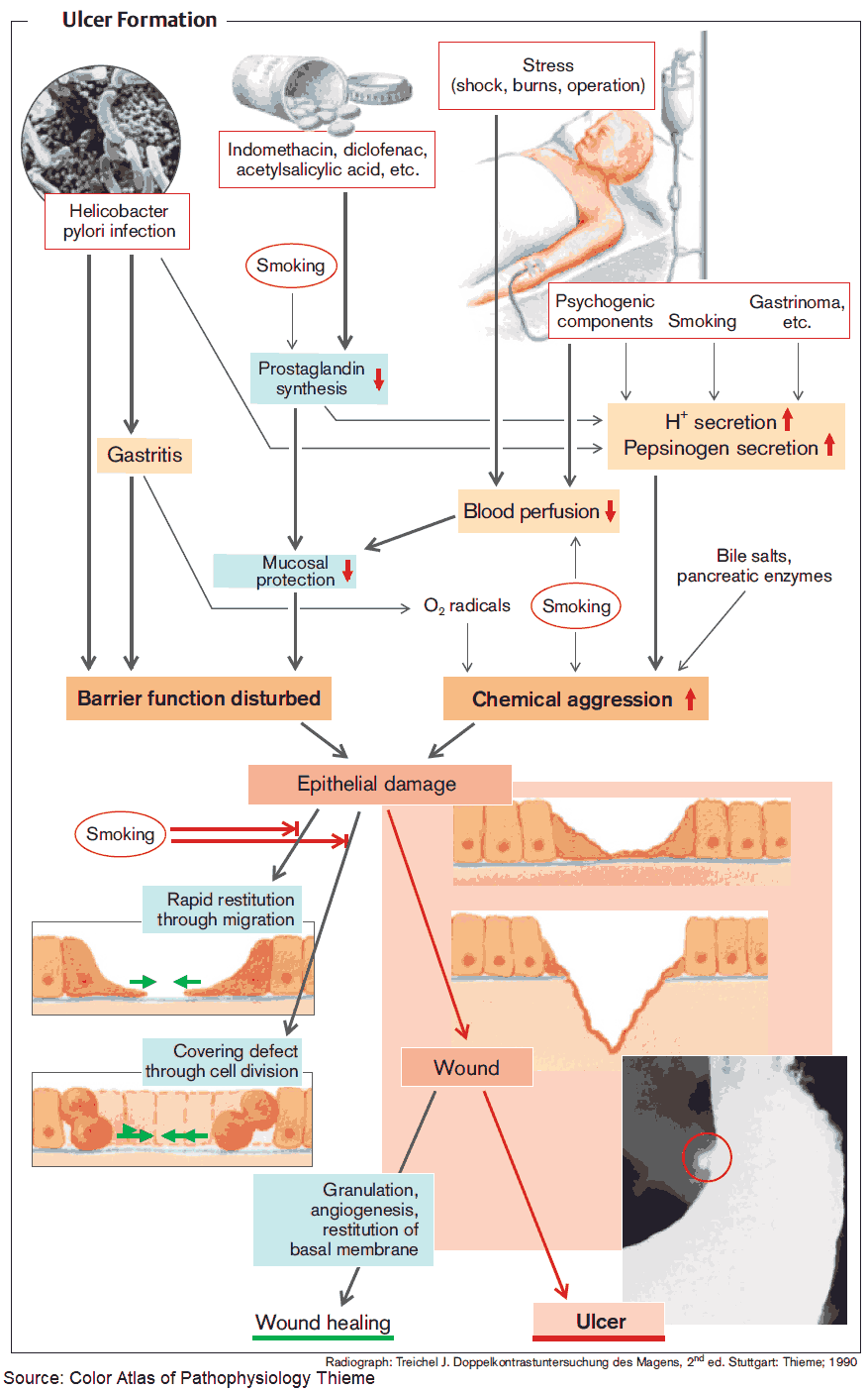Pathophysiology of Gastric Ulcer Formation