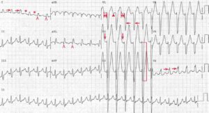 ECG Case 155: Sinus Tachycardia with Intraventricular Conduction Delay ...