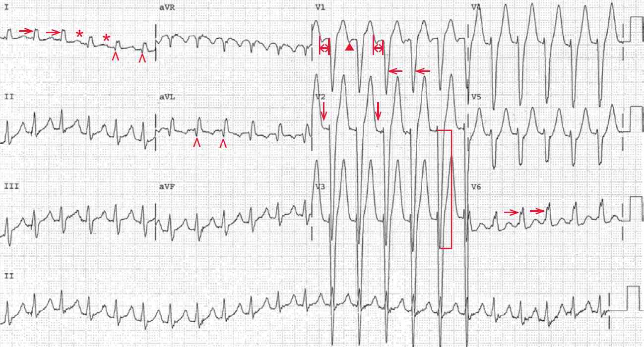 Sinus tachycardia with intraventricular conduction delay (IVCD)