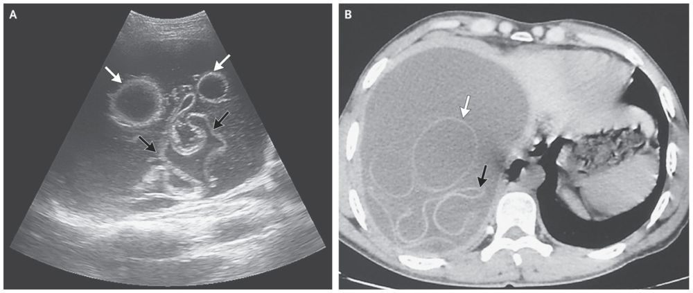 US and CT of the abdomen showing hydatid cysts in the liver