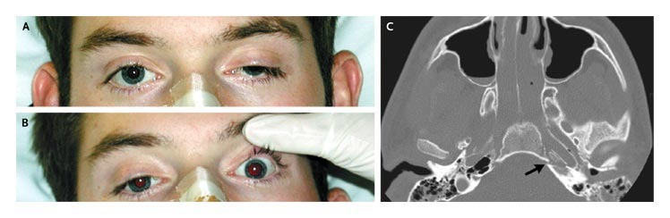 Ptosis (Panel A) and anisocoria (Panel B). A high-resolution CT scan revealed a complex fracture of the sella turcica (Panel C, arrow) and of the skull base (not shown), with impingement of the bony nerve canals and a C1 fracture