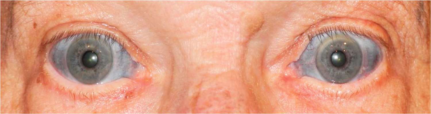 Read more about the article Bluish Discoloration of Sclerae