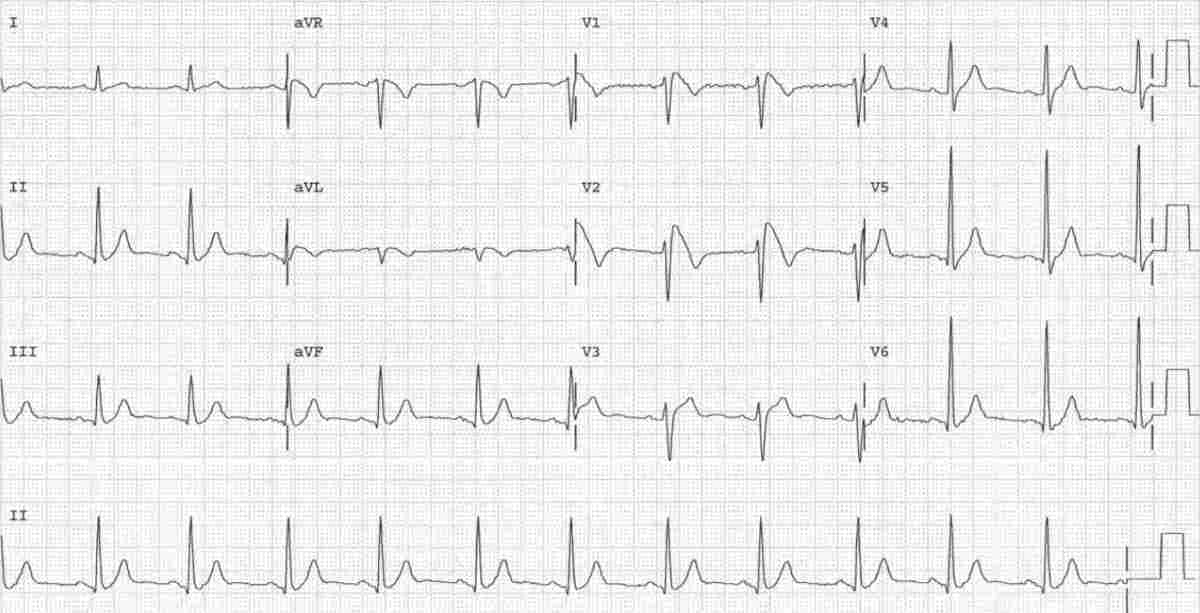 Read more about the article ECG Case 156