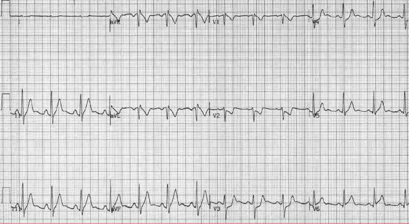 Read more about the article ECG Case 157