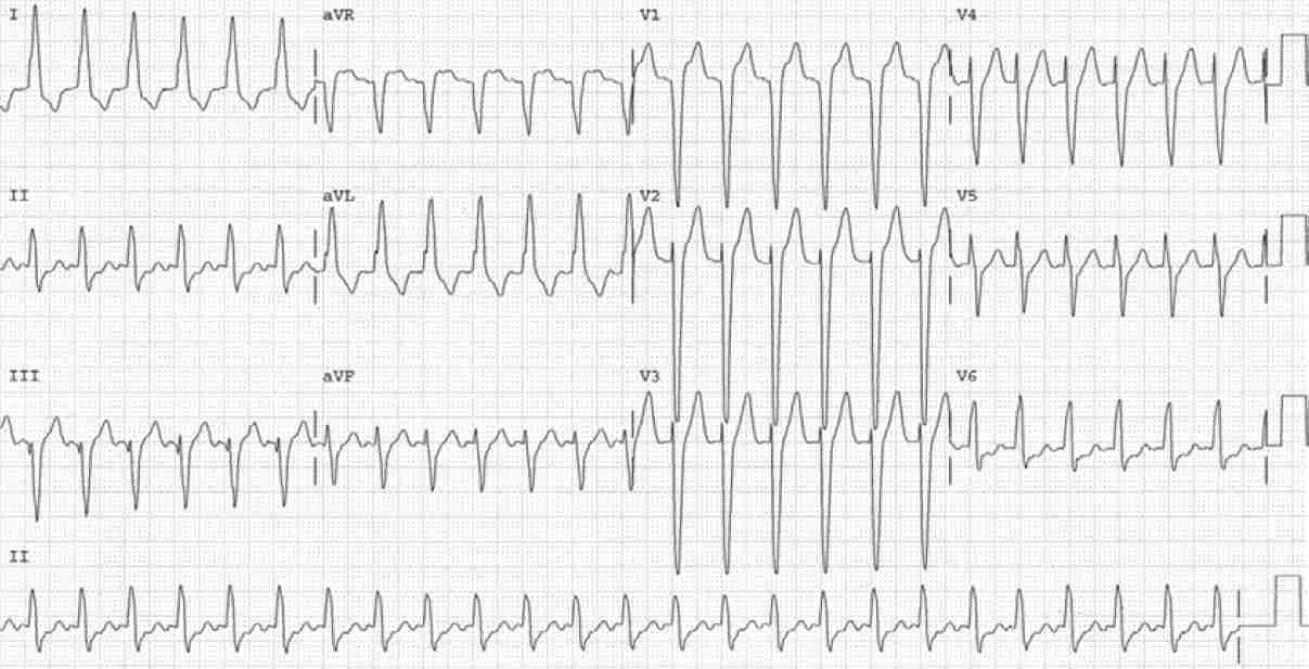 Read more about the article ECG Case 158