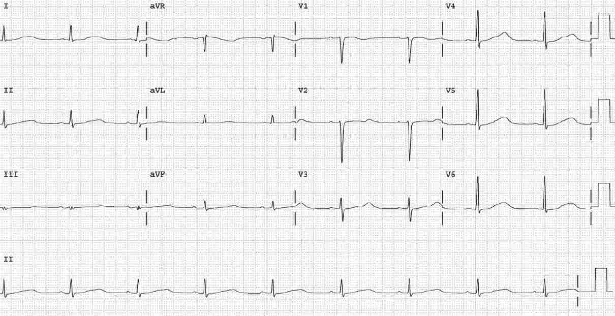 Read more about the article ECG Case 159