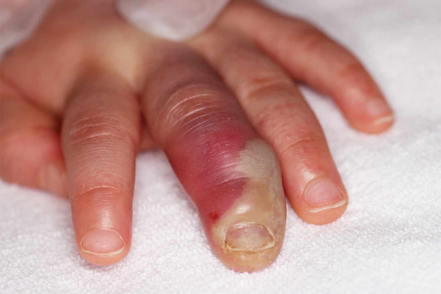 Read more about the article Erythema and Swelling of Finger