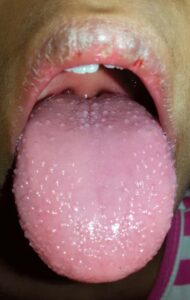 Fever, Rash and Tongue Changes - Manual of Medicine