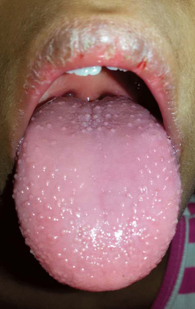 Read more about the article Fever, Rash and Tongue Changes
