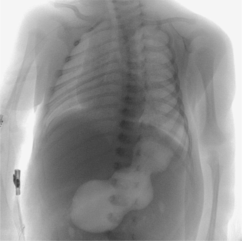 Upper gastrointestinal radiography showing a distended, air-filled stomach