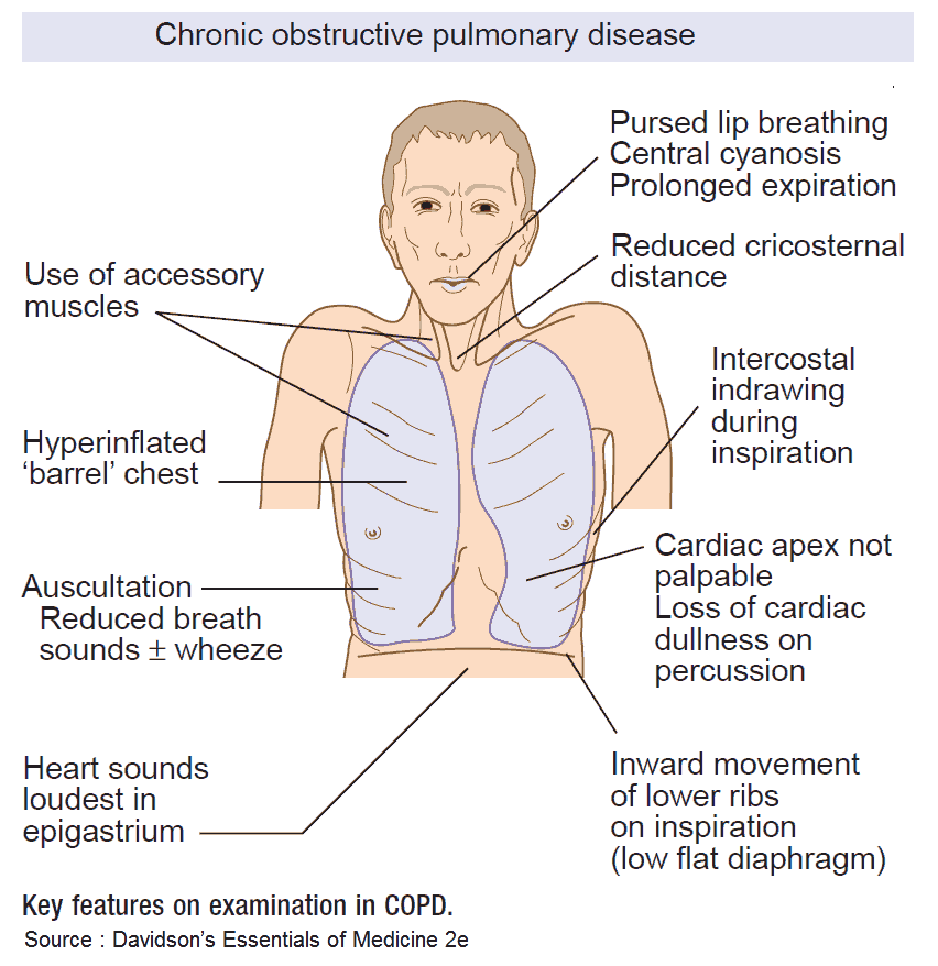 Key features (signs) on examination in COPD (Emphysema and Chronic bronchitis)