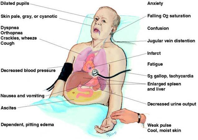 Symptoms and Sign of Chronic Heart Failure