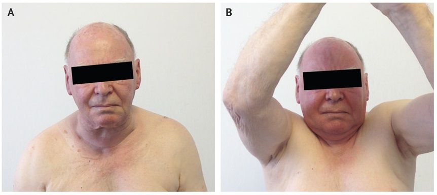 Read more about the article Reversible Facial Congestion After Elevation of Both Arms