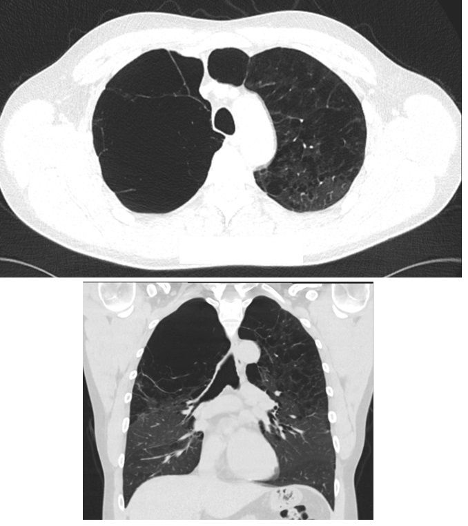 Chest CT showing numerous large apical bullae