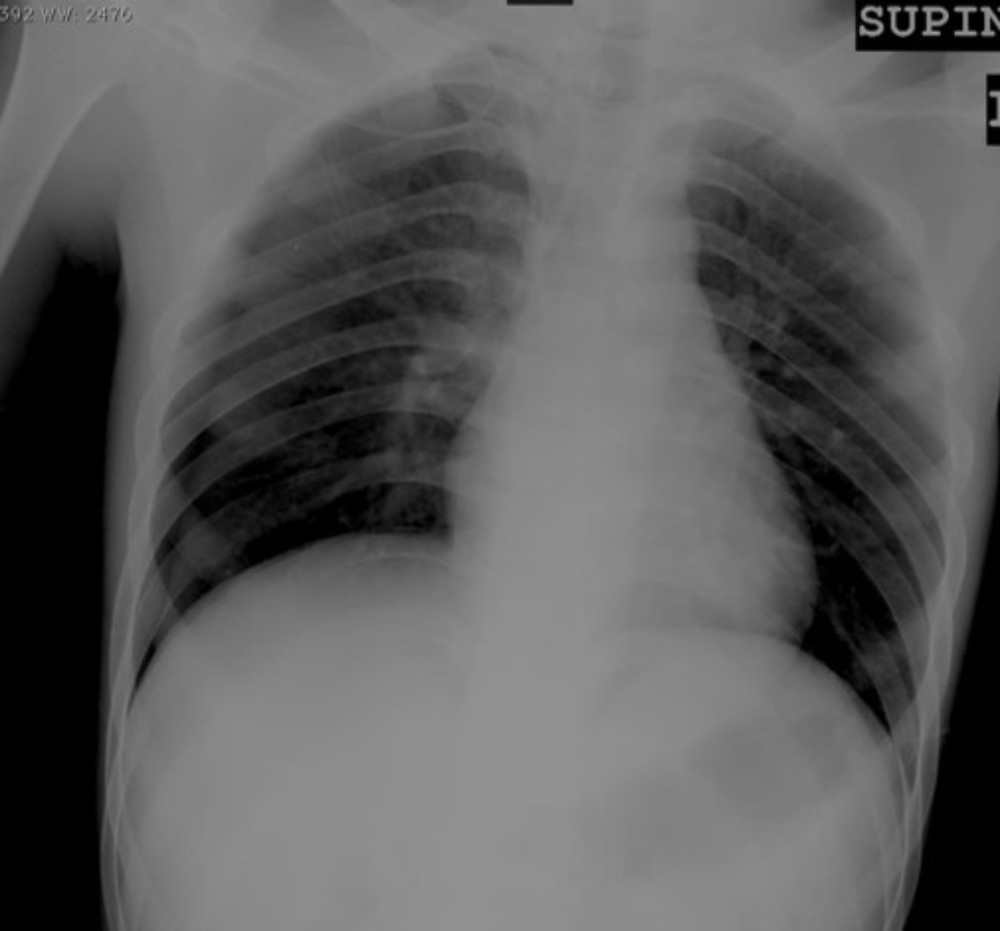 Read more about the article Dyspnea After Insertion of Central Venous Catheter