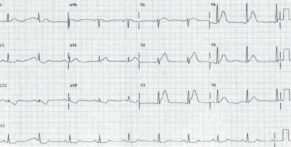 Read more about the article ECG Case 160