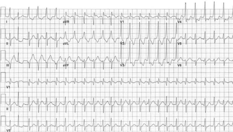 Read more about the article ECG Case 161