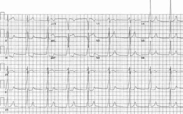 Read more about the article ECG Case 162